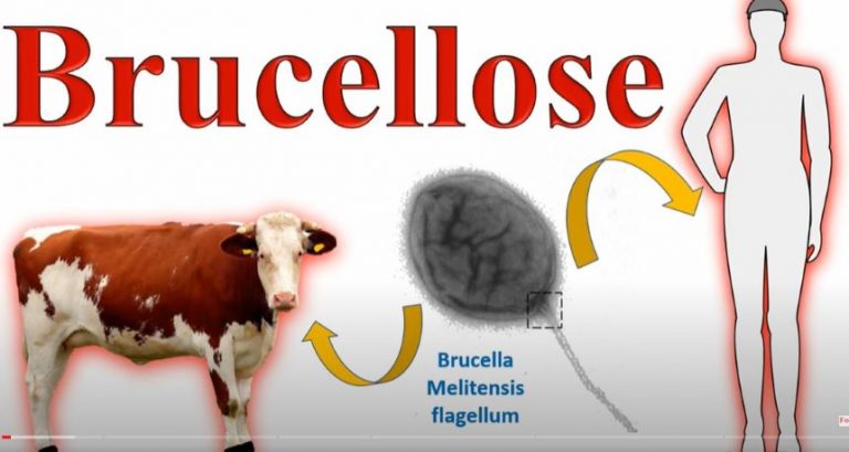 Brucellose humaine